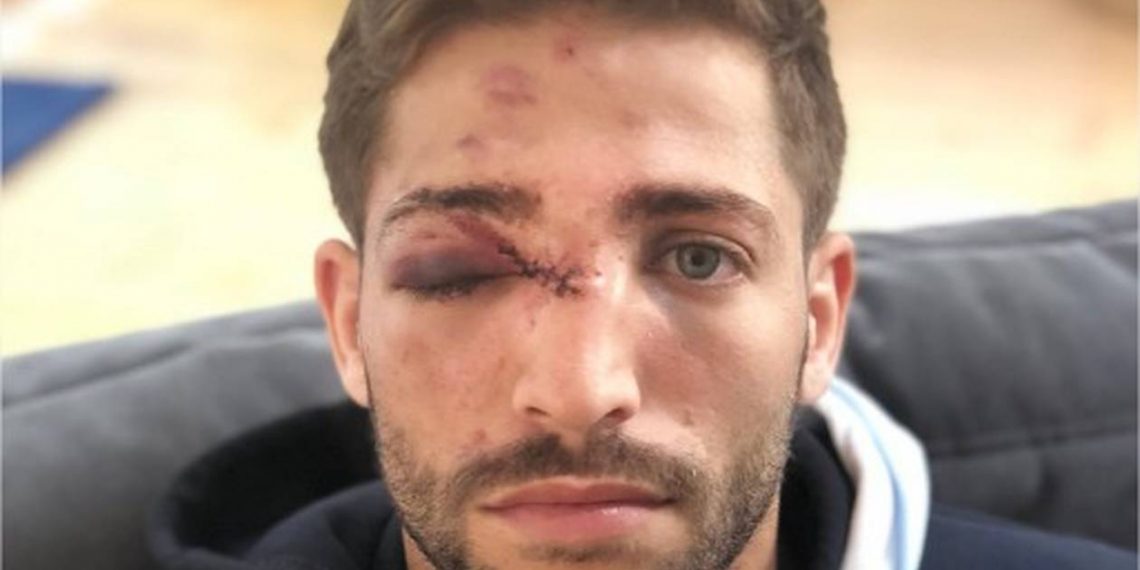 Photo: L’impressionnante blessure au visage de Teddy Iribaren