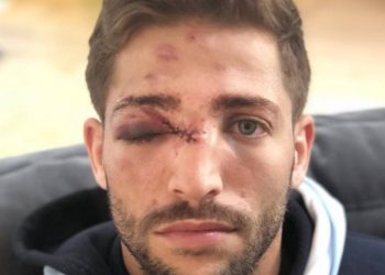 Photo: L’impressionnante blessure au visage de Teddy Iribaren