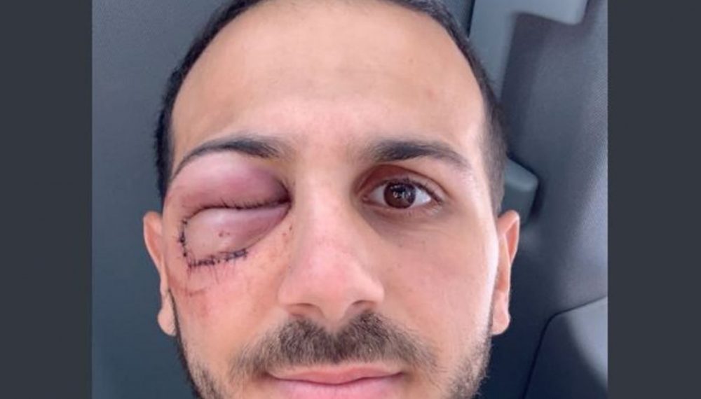 Âmes sensibles s’abstenir : Kylian Hamdaoui défiguré après son télescopage avec Tony Ensor